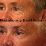 Eyelid (Blepharoplasty) Before & After Patient #6559