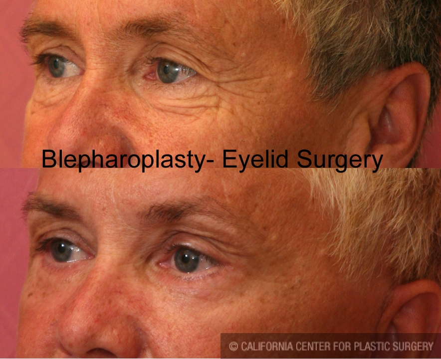 Eyelid (Blepharoplasty) Before & After Patient #6559