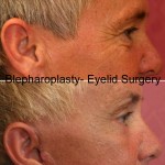 Eyelid (Blepharoplasty) Before & After Patient #6559