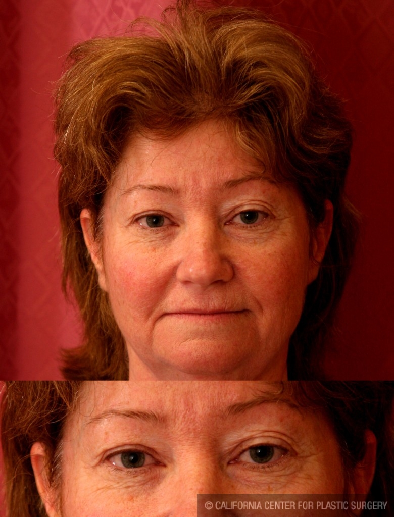 Eyelid (Blepharoplasty) Before & After Patient #6528