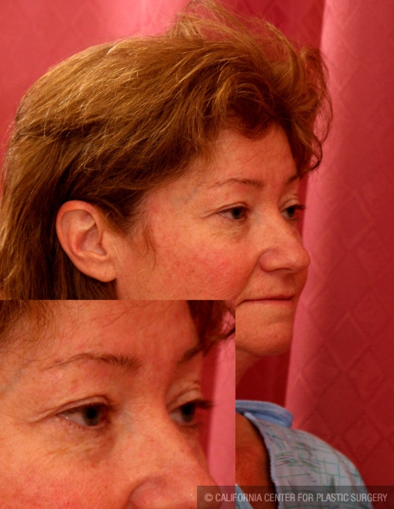 Eyelid (Blepharoplasty) Before & After Patient #6528