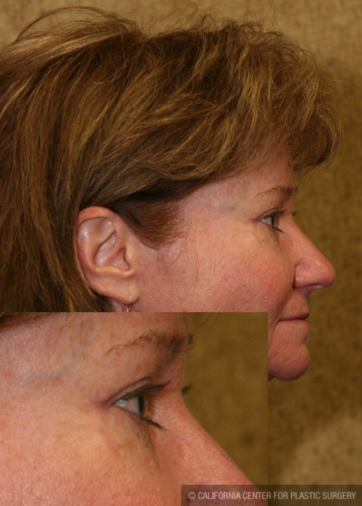 Eyelid (Blepharoplasty) Before & After Patient #6528