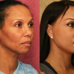 Facelift Before & After Patient #6773