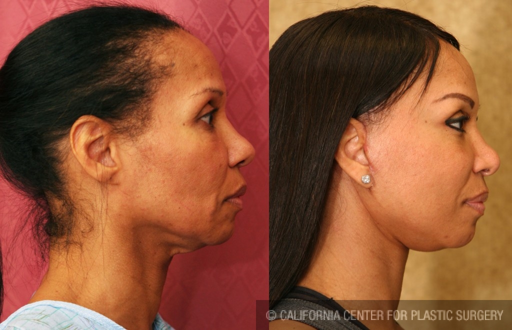 Facelift Before & After Patient #6773