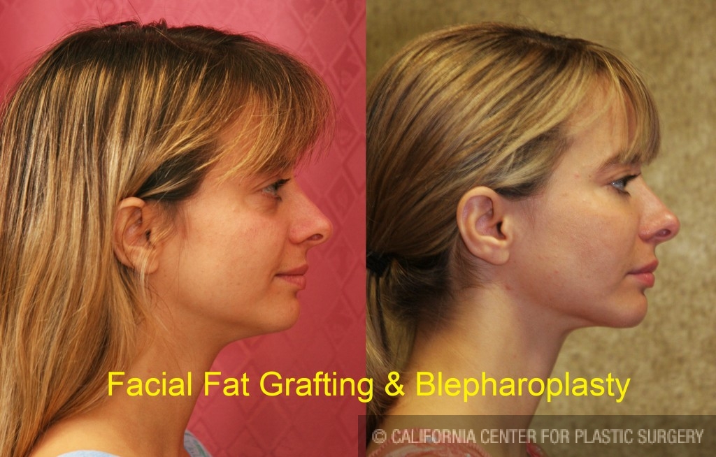 Facial Fat Grafting Before & After Patient #6600