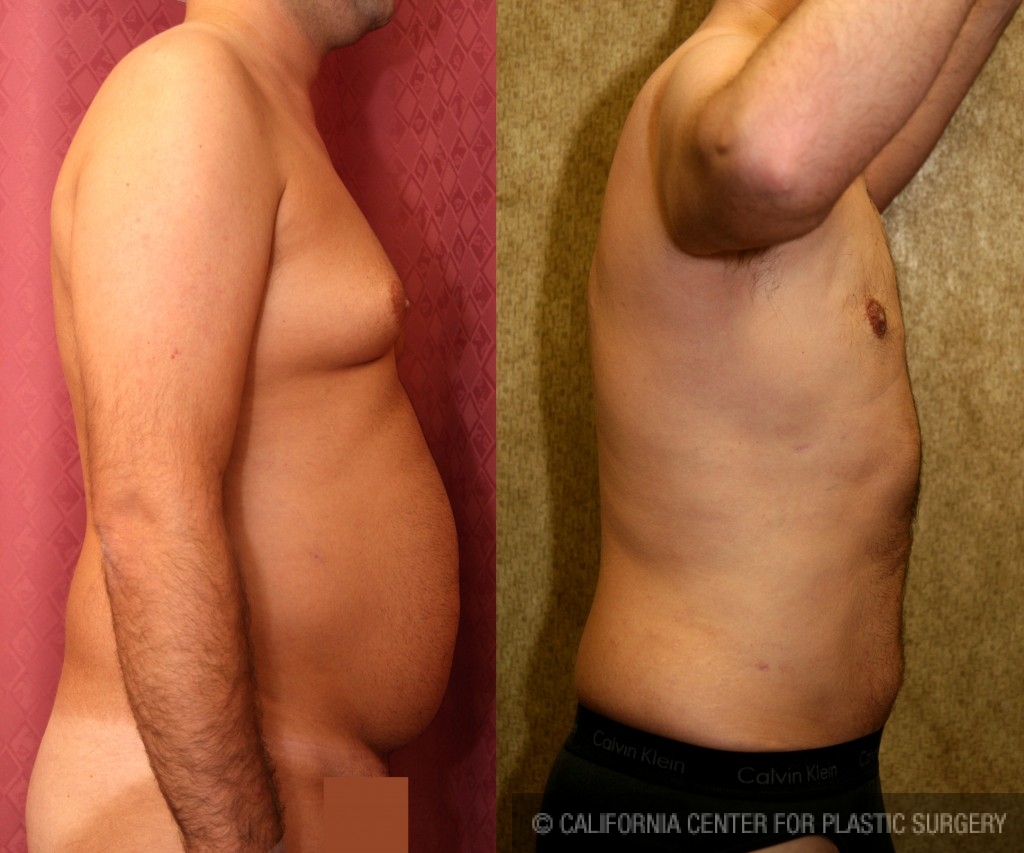 Male gynecomastia (breast) reduction Before & After Patient #6809