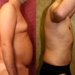 Male gynecomastia (breast) reduction Before & After Patient #6809