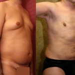Male gynecomastia (breast) reduction Before & After Patient #6809