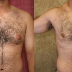 Male gynecomastia (breast) reduction Before & After Patient #6820