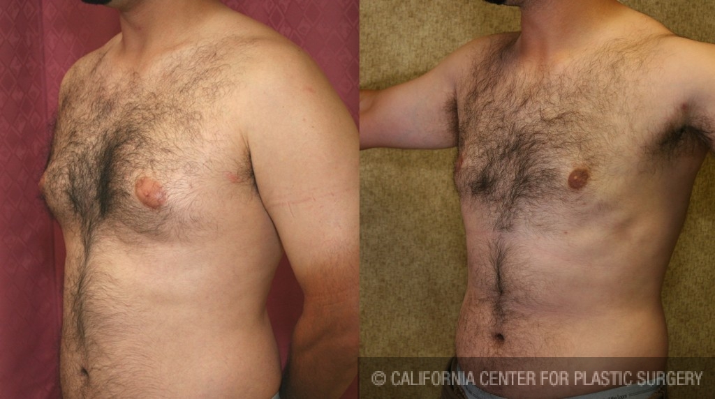 Male gynecomastia (breast) reduction Before & After Patient #6820