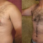 Male gynecomastia (breast) reduction Before & After Patient #6820