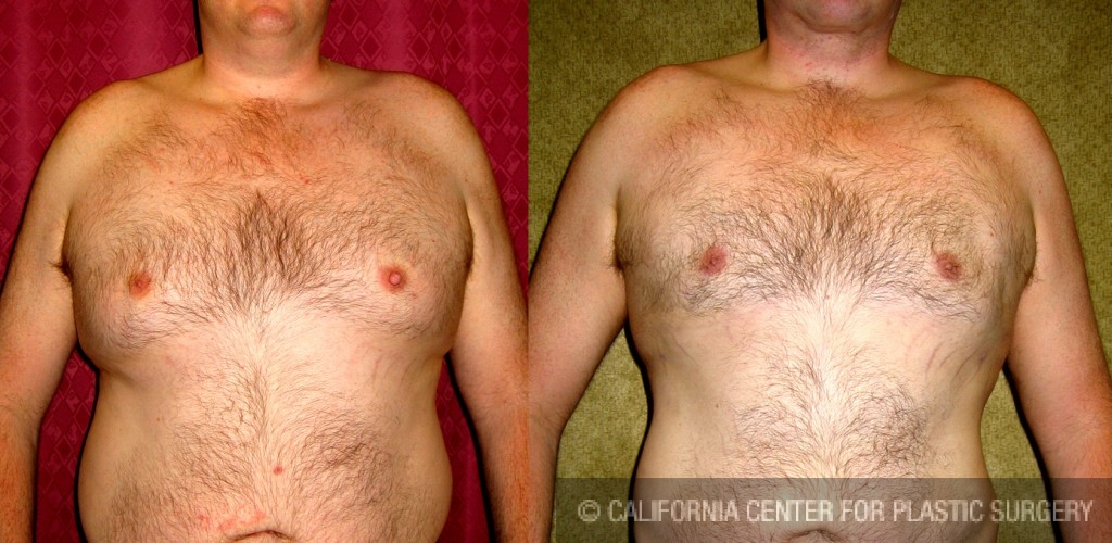 Male gynecomastia (breast) reduction Before & After Patient #6827