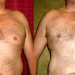 Male gynecomastia (breast) reduction Before & After Patient #6827