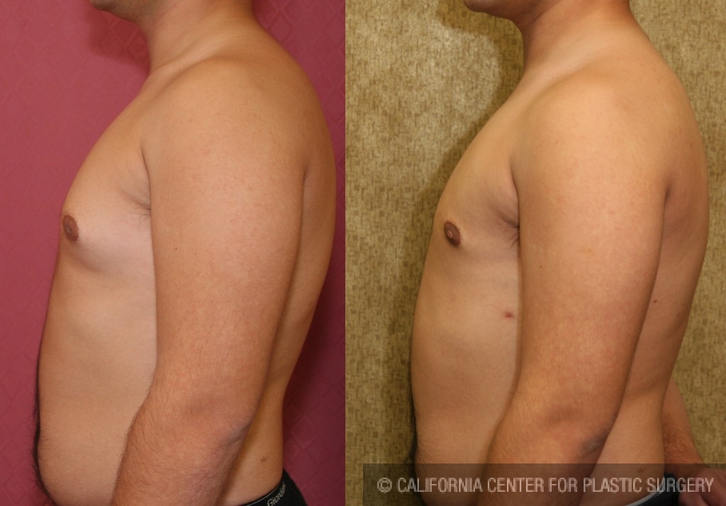 Male gynecomastia (breast) reduction Before & After Patient #6852