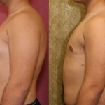 Male gynecomastia (breast) reduction Before & After Patient #6852