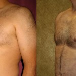 Male gynecomastia (breast) reduction Before & After Patient #6843
