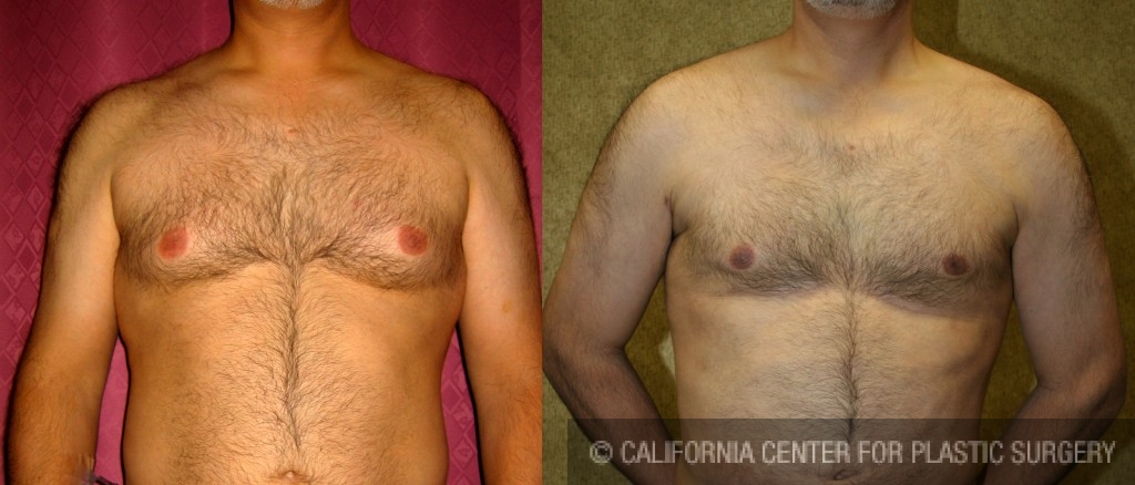 Male gynecomastia (breast) reduction Before & After Patient #6843