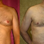 Male gynecomastia (breast) reduction Before & After Patient #6843