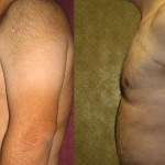 Male gynecomastia (breast) reduction Before & After Patient #6843