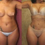 Liposuction Abdomen Medium Before & After Patient #5552