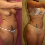 Liposuction Abdomen Medium Before & After Patient #5552