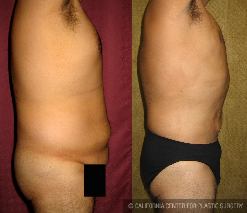 Male Liposuction Abdomen Before & After Patient #5622