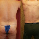 Male Liposuction Abdomen Before & After Patient #5665