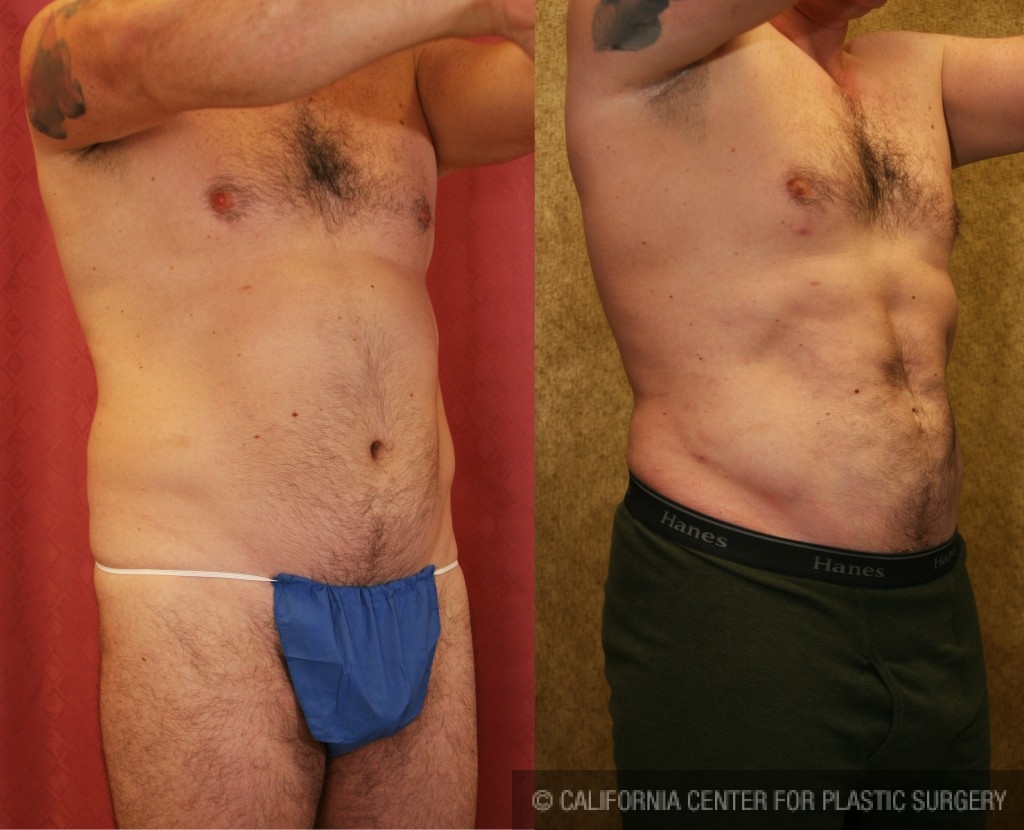 Patient #6031 Male Tummy Tuck (abdominoplasty) Before and After Photos  Beverly Hills - Plastic Surgery Gallery Los Angeles, CA - Dr. Sean Younai