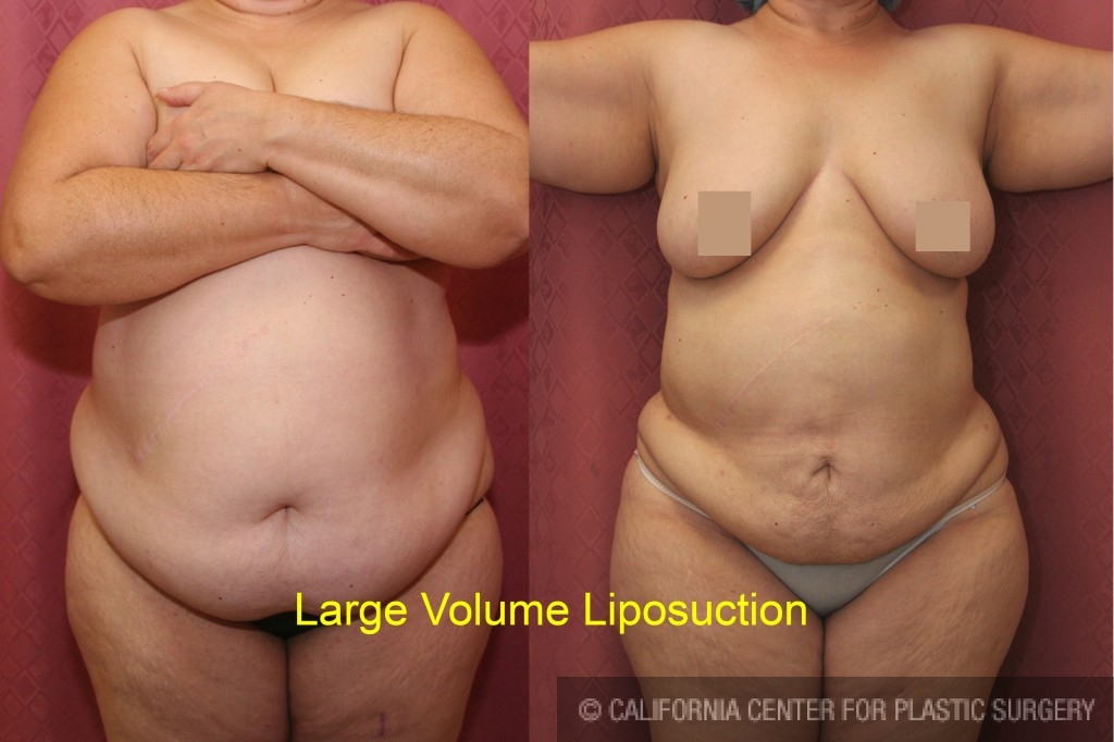 Liposuction Abdomen Plus Size Before & After Patient #5585