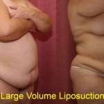 Liposuction Abdomen Plus Size Before & After Patient #5585