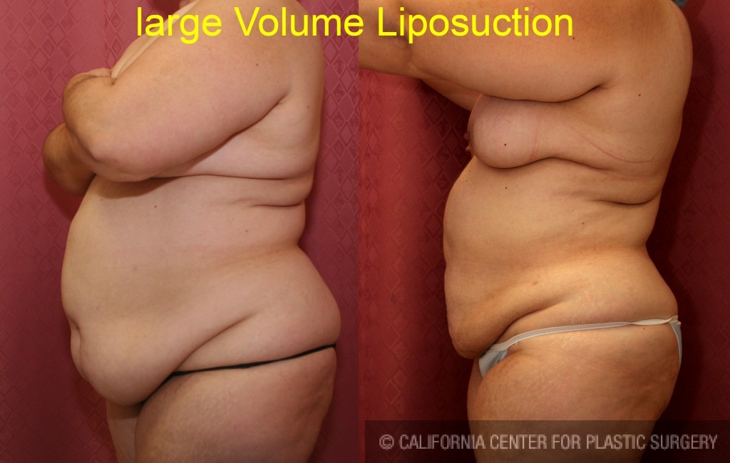 Liposuction Abdomen Plus Size Before & After Patient #5585