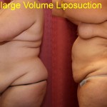 Liposuction Abdomen Plus Size Before & After Patient #5585