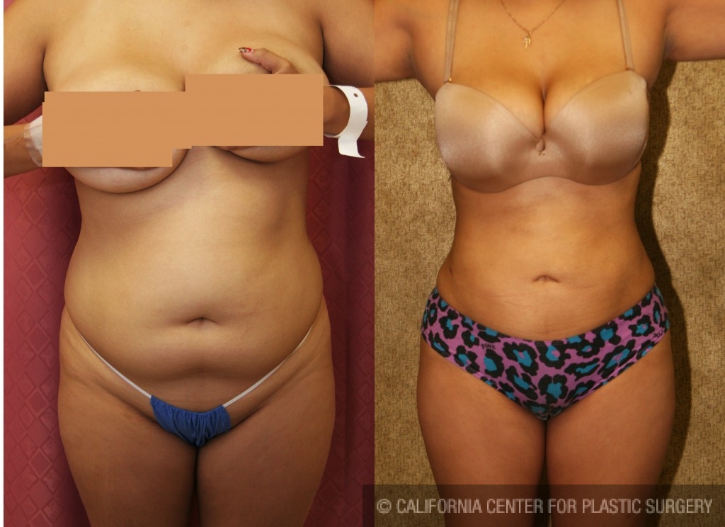 Liposuction Before & After Gallery: Patient 16