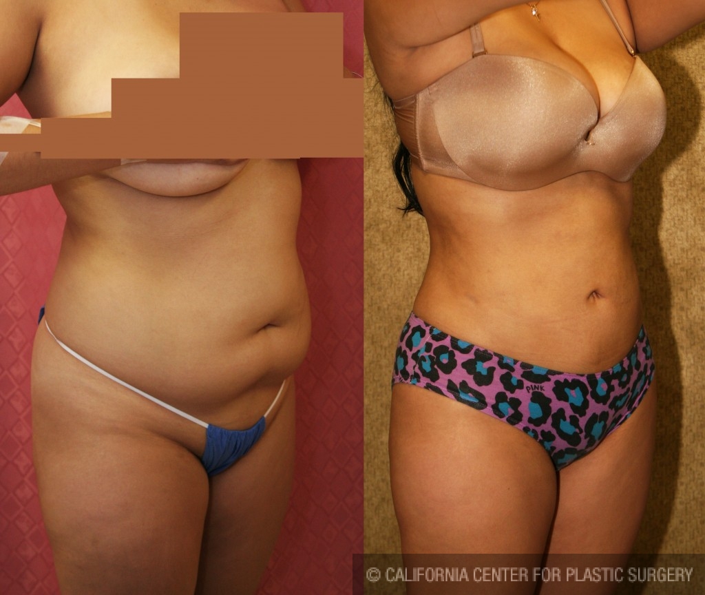 Liposuction Abdomen Medium Before & After Patient #5544