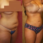 Liposuction Abdomen Medium Before & After Patient #5544