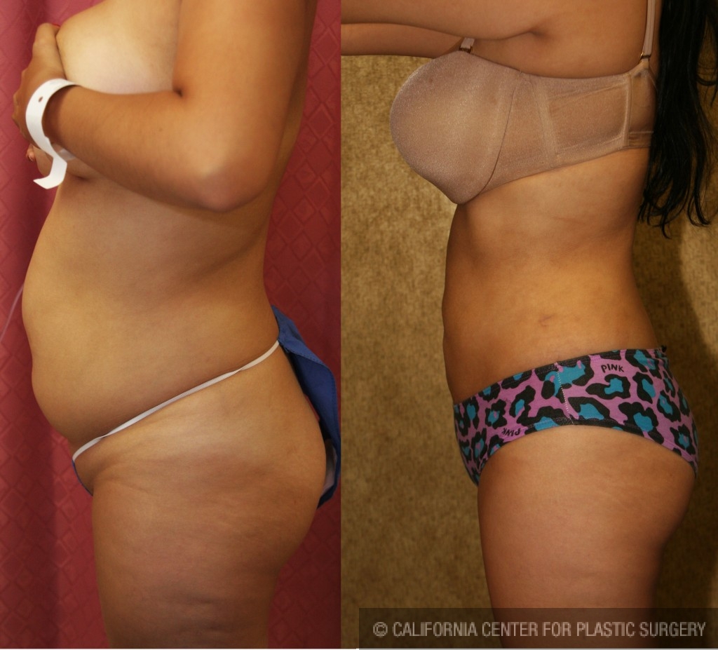 Liposuction Abdomen Medium Before & After Patient #5544