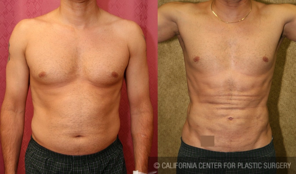 Patient #5646 Male Liposuction Abdomen Before and After Photos