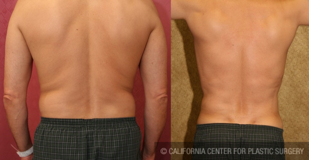 Patient #5646 Male Liposuction Abdomen Before and After Photos