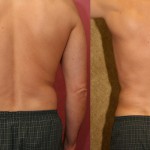 Male Liposuction Abdomen Before & After Patient #5646