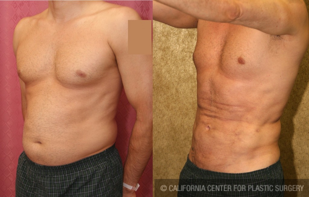 Male Liposuction Abdomen Before & After Patient #5646