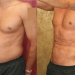 Male Liposuction Abdomen Before & After Patient #5646