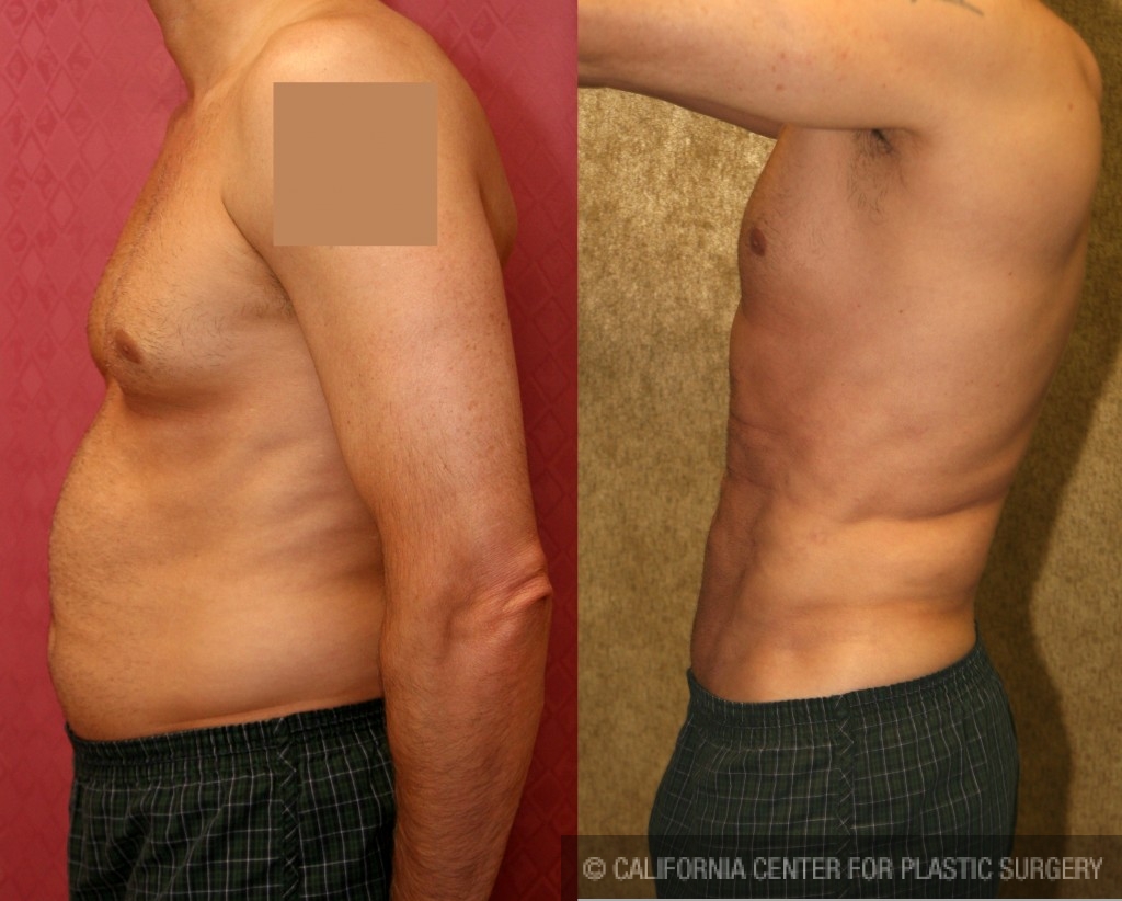 Liposuction of the 'love handles' or flanks