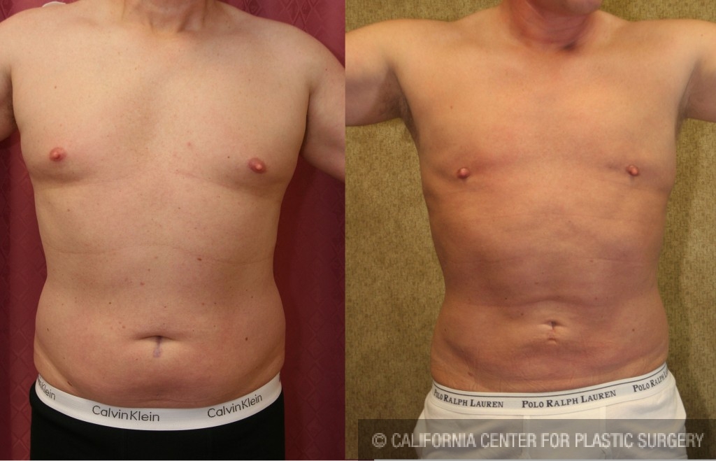 Male Liposuction Abdomen Before & After Patient #5651