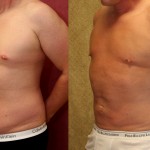 Male Liposuction Abdomen Before & After Patient #5651
