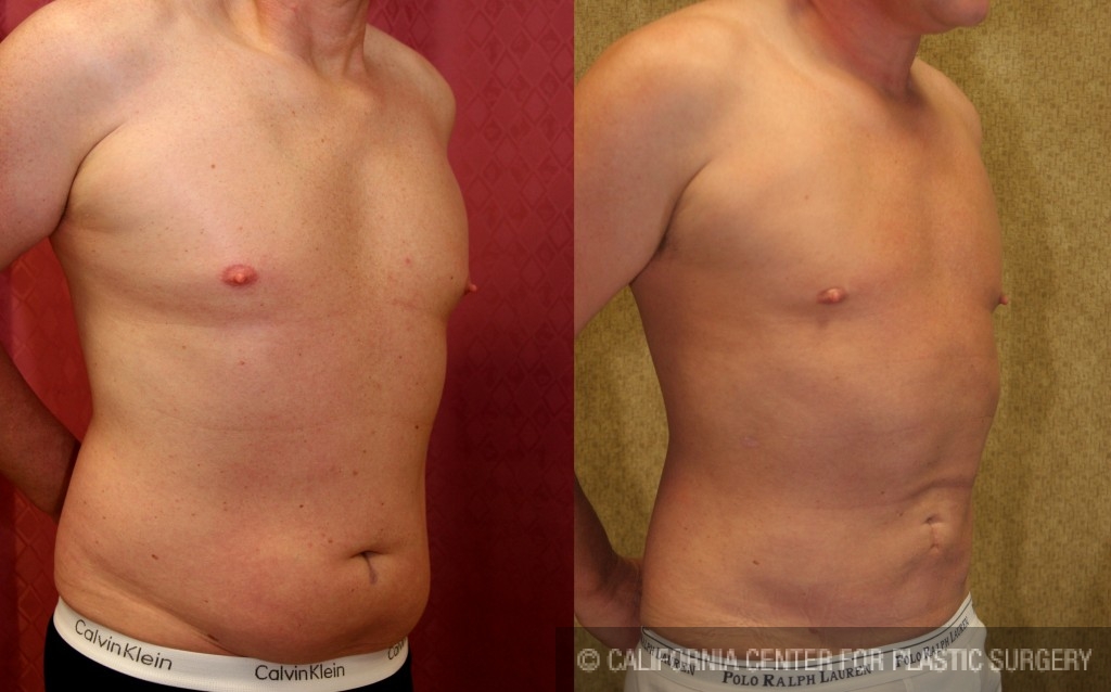 Male Flanks Liposuction - KleinLipo - Liposuction Surgery of Orange County