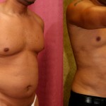 Male Liposuction Abdomen Before & After Patient #5656