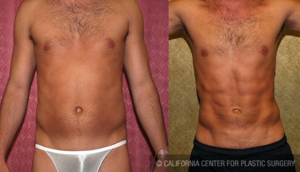 Male Liposuction Abdomen Before & After Patient #5614