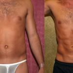 Male Liposuction Abdomen Before & After Patient #5614