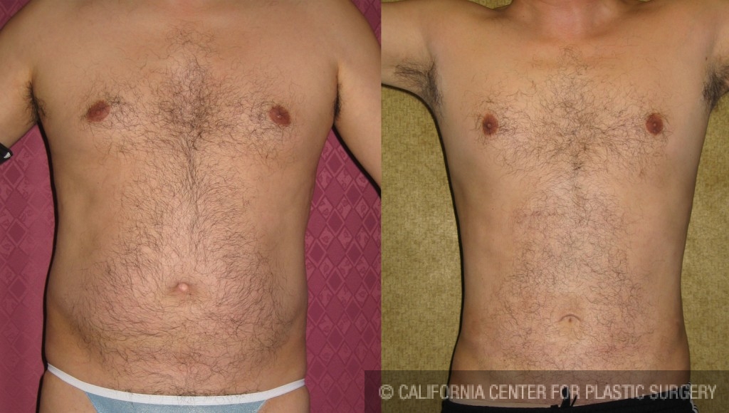 Male Liposuction Abdomen Before & After Patient #5629