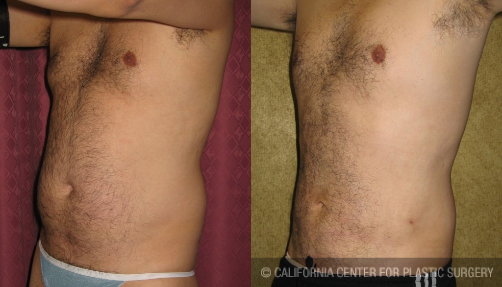 Male Liposuction Abdomen Before & After Patient #5629